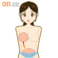 「橫行下腹直肌皮瓣」手術<br>將病人下腹的脂肪、肌肉及皮瓣取出，開闢通道將腹部組織180度「扭轉」到胸部形成新乳房。