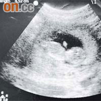 10年1月13日 林太下體分泌情況無改善，到荃灣港安向婦產科專科求診，照超聲波發現已懷孕三個月，胎兒體長4.52厘米