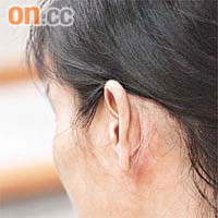 陳小姐接受腮腺瘤切除微創手術後，疤痕隱藏於耳背。	（蘇文傑攝）