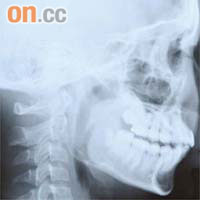 較年幼矯齒患者的頭頸Ｘ光，脊椎骨之間亦未填滿。