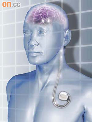 新的深腦刺激儀器，能為病人解決「無電」煩惱。