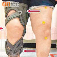 患者佩戴膝支架有助減少內側關節壓力，減慢關節磨損。