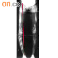 膝內側關節退化患者髖骨、膝關節及腳踝並非成一直線，會出現「O形腿」。