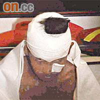 一名傷者被人「爆樽」扑穿頭。