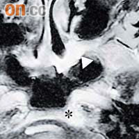 險盲<br>磁力共振掃描顯示，陳女士的鼻咽癌逼近視覺神經。	（箭嘴示白色位置）