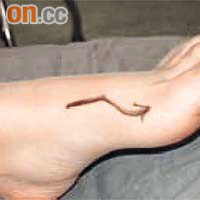 曾有患拇趾嵌甲的病人需在腳趾中央開刀做手術，但醫生錯誤在拇趾側開刀。