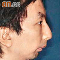 李先生接受牽引成骨術前下顎明顯縮後，手術後臉部結構回復正常。