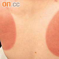 皮膚經曬傷後會出現紅腫。