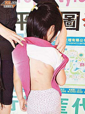 女童背脊留下數條清晰可見的瘀痕。	（吳欽旺攝）