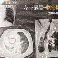 茵茵左右肺的X光照片顯示肺部嚴重移位，造成氣管壓迫，呼吸困難。
