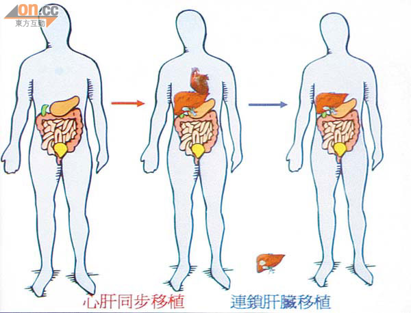 首宗心肝同時移植手術 0822-00176-002b1