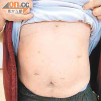 縮胃手術以微創方式進行，病人肚皮只有數個小傷口。