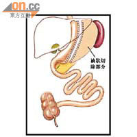 縮胃手術<br>縮胃手術將胃部儲存食物的部分切除，令病人小量進食也感飽肚。