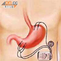 醫生會將三組電極接駁到病人的胃部，再將電極接駁至腹部皮下的電池圈（圓形）及脈衝發動器（長方形）。
