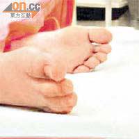 山埃中毒男童的腳部仍紅潤，表示紅血球帶有氧氣，只是細胞中毒無法使用氧氣。	（《香港醫學雜誌》圖片）
