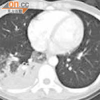 女病人的電腦掃描顯示右邊肺部因嚴重發炎導致潰爛。（《European Respiratory Joural》圖片）