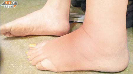 蔡小姐左腳腳趾尾被蜈蚣咬傷，整隻左腳紅腫。