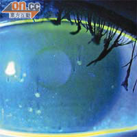 佩戴隱形眼鏡後不適，可能出現的病況：角膜表層受損。