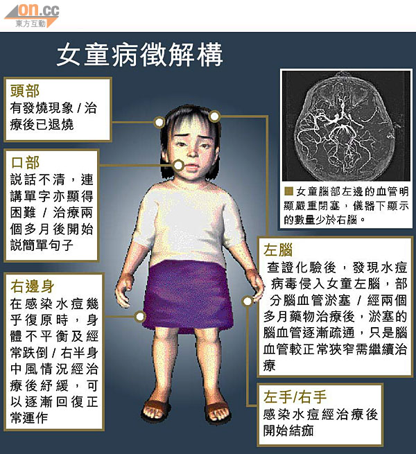 水痘病毒上腦三歲女半癱 1031-00176-017b3