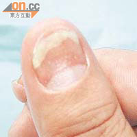 牛皮癬可影響指甲，令指甲變白似真菌感染。