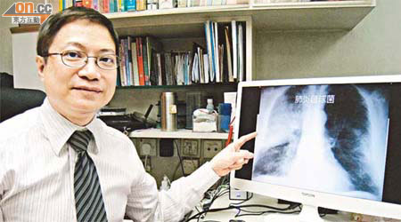 伍永強指肺炎是常引發的併發症之一，從Ｘ光片可見患者其中一邊肺部「花晒」。