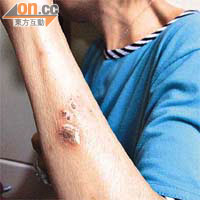 袁太左手手臂被蚊叮的傷口嚴重至發炎，久久未能痊愈。