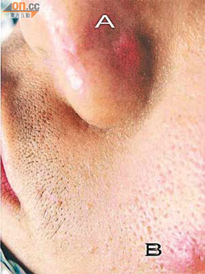 滾珠槍彈頭在少年鼻孔的軟組織引致紅腫（Ａ），表面看來像一般暗瘡（Ｂ）。（香港急症醫學期刊圖片）
