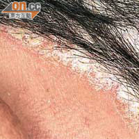 頭皮牛皮癬患者病徵多與濕疹患者不同，患處多位於頭髮邊緣，規律明顯。
