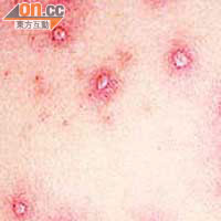 顯微鏡下的水痘病毒。