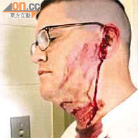 Aron Embry左臉及耳朵受傷流血。	（電視畫面）