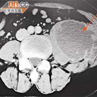 結核菌可入侵脊骨兩側的「腰大肌」，掃描影像顯示受感染的右側腰大肌（箭嘴示）嚴重腫脹。