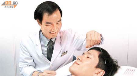 張樟進（左）表示，針灸刺激頭部穴位可疏通經絡、行氣活血、調節身體機能。上圖：頭皮是最常用於治療中風後抑鬱的針灸部位。