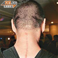 鄧達智大方展示頸後七吋長疤痕。	（何天成攝）