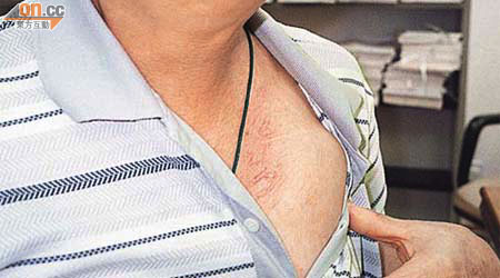心臟起搏器一般安裝在病人的胸口位置。	（資料圖片）