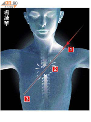 子彈左肩近頸處（1) 射入，打碎脊柱骨（2) 及穿肺，卡在右邊第五條肋骨處（3) 。