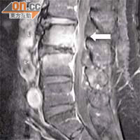 患者的磁力共振檢查發現脊椎第三至第四節出現異常（箭嘴示），抽取樣本化驗證實感染虹鱒鏈球菌。