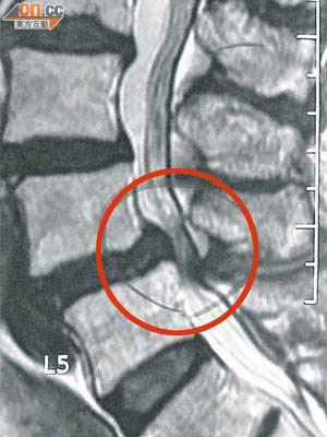 馮月娥的Ｘ光片顯示，她因椎管太狹窄及不穩，令腰椎神經及血管受壓（圈着的位置）。