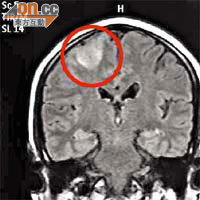 腦掃描影像顯示42歲孕婦的右腦部分異常，導致左半身癱瘓。（《香港醫學雜誌》圖片）