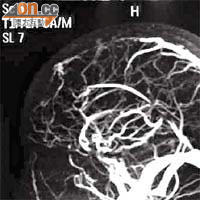 顯示該孕婦腦內部分靜脈出現栓塞。（《香港醫學雜誌》圖片）