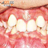 矯齒前<BR>牙齒不齊咬合過深影響清潔、咀嚼及發音，長遠更影響健康。