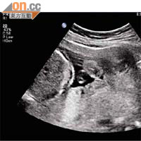 胎盤過低<br>研究發現，若胎盤位置過低，產後出血風險高達五倍。
