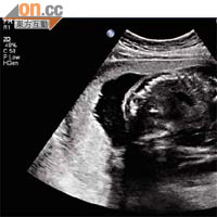 胎盤偏頂<br>胎盤位置偏頂時，患妊娠高血壓的機會較正常位置高二點二七倍。