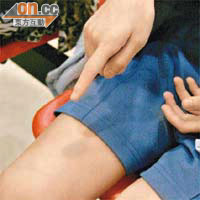 男生展示小腿被打瘀痕。