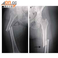 非典型骨折患者的股骨中段骨折後斷開。（受訪者提供）