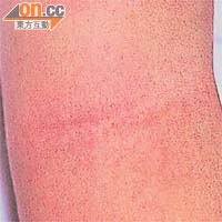 猩紅熱可令患者軀幹及四肢出現皮疹。