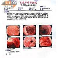 內地醫院透過腸內窺鏡檢查迅即驗出病人患腸癌。