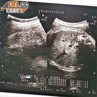 六月廿二日在港產檢時照超聲波，涉事產婦腹中胎兒無異樣，並有三千三百多克重。