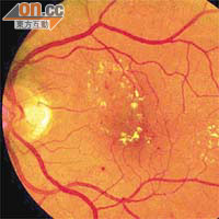 美國及澳洲科學家發現，透過眼底血管檢查，可及早診斷老年癡呆症。