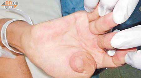 為中風病人清潔手指時，須強行拉開手指關節。