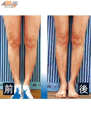 患Ｏ形腳的彭女士接受治療前膝部呈向內翻的現象，治療兩個月後Ｏ形腳漸見改善。	（受訪者提供）